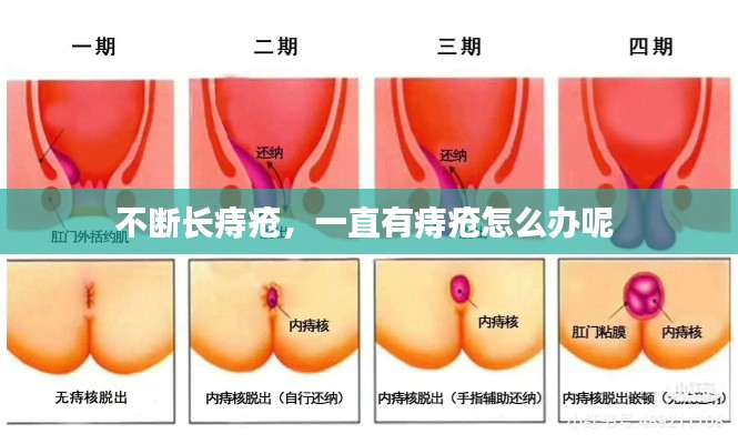 不断长痔疮,一直有痔疮怎么办呢